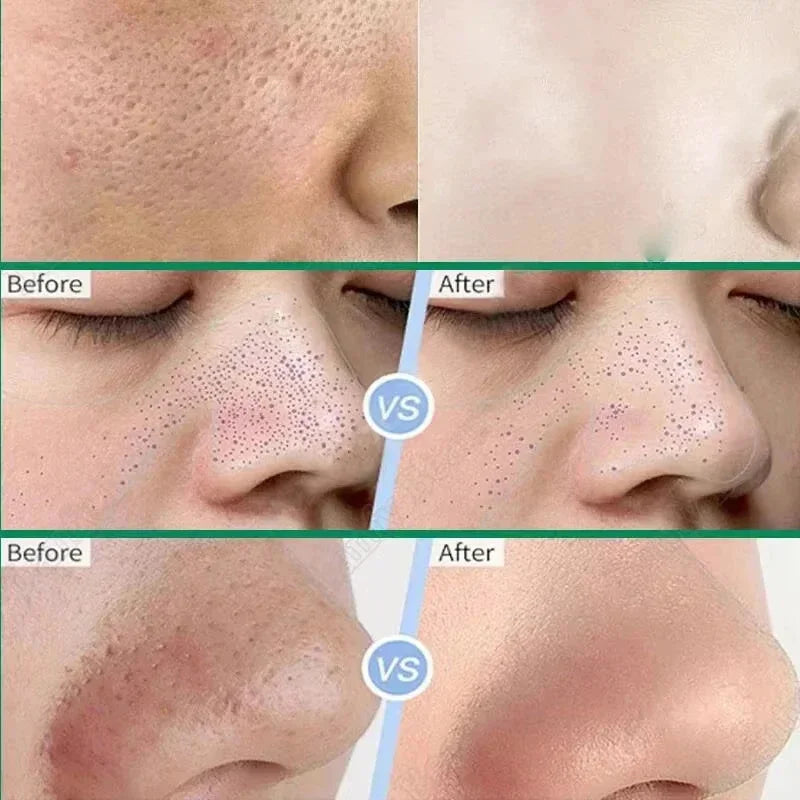 Salicylic Acid Pore Shrinking Mask Quick Elimination Large Pores Remove Blackehead Tighten Face Smooth Skin
